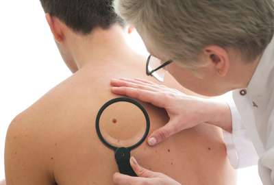 Doctor examines a mole on a person's back with a magnifying glass.